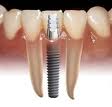 Dental Implants Dallas