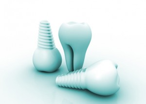 dental implants Uptown Dallas