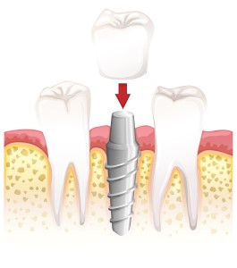 dental implants Uptown Dallas