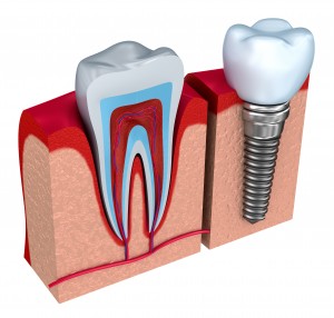 Dallas dental implants