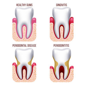 periodontal disease Dallas