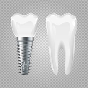 implant dentistry Dallas